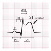 Diagnosis Banding Elevasi Segmen ST pada Elektrokardiografi