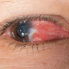 Pterigium Sebagai Prediktor Kejadian Melanoma Kutaneus