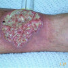 Membedakan Pyoderma Gangrenosum dari Gangrene