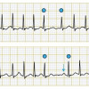 Parameter Gelombang P sebagai Prediktor Risiko Stroke pada Atrial Fibrilasi