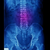 Perbedaan Spondylosis, Spondylolysis, dan Spondylolisthesis Lumbal