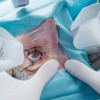 Indikasi Laser Iridotomy Peripheral pada Glaukoma