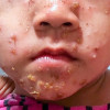 Antibiotik Oral atau Topikal untuk Impetigo