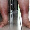 Red Legs: Membedakan Selulitis dari Penyebab Lain