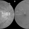 Brolucizumab dalam Tata Laksana Diabetic Macular Edema (DME)