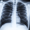 Rontgen Toraks Normal Tidak Dapat Menyingkirkan COVID-19