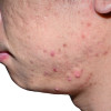 Membedakan Acne Vulgaris dengan Fungal Acne