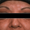 Terapi Laser pada Xanthelasma
