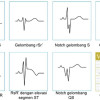 Makna Klinis Fragmented QRS