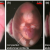 Persalinan Pervaginam Aman untuk Fetus dengan Gastroschisis