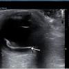 Point-of-Care Ultrasonography untuk Diagnosis Ablatio Retina
