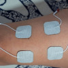 Stimulasi Elektrik Neuromuskular untuk Kelemahan Otot di ICU