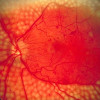 Terapi Laser VS Anti-Vascular Endothelial Growth Factor pada Retinopati Diabetik