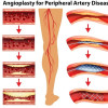 Perbandingan Resorbable Scaffold dan Angioplasti pada Penyakit Arteri Infrapopliteal – Telaah Jurnal Alomedika