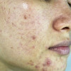 Pemberian Isotretinoin untuk Terapi Acne Vulgaris