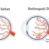 Efikasi Fenofibrate pada Retinopati Diabetes