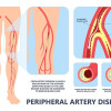 Pedoman Penanganan Penyakit Arteri Perifer pada Ekstremitas Bawah 2024 – Ulasan Guideline Terkini