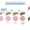 Opsi Terapi Non-alcoholic Fatty Liver Disease (NAFLD) dan Non-alcoholic Steatohepatitis (NASH)