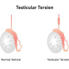 Tingkat Keberhasilan Reduksi Manual Torsio Testis – Telaah Jurnal Alomedika