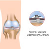 Faktor-Faktor yang Mempengaruhi Penentuan Terapi pada Cedera ACL