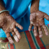 Lepra: Eliminasi, Vaksinasi, dan Kemoprofilaksis