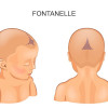 Kaitan Ubun-Ubun Menonjol pada Bayi Demam dengan Meningitis
