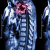 Peran Radiasi pada Kasus Metastasis ke Vertebrae
