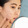 Pedoman Tata Laksana Acne Vulgaris – Ulasan Guideline Terkini