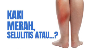 Video Alomedika - Membedakan Kaki Merah: Selulitis Atau Penyebab Lainnya