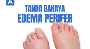 Video Alomedika - Red Flags Edema Perifer