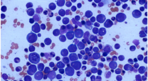 Interpretasi Hitung Jenis Leukosit - Shift to the Left pada Neutrofil