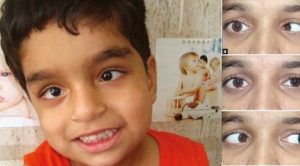 Pendekatan Klinis pada Pasien dengan Kelemahan Saraf Abdusen