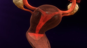 Red Flag Perdarahan Intermenstrual