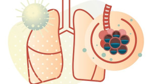 Profilaksis Emboli Paru pada Pasien COVID-19