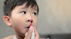 Manfaat Asam Traneksamat dalam Manajemen Epistaksis