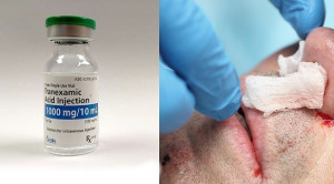 Efektivitas Asam Traneksamat Topikal untuk Epistaksis pada Pengguna Antiplatelet