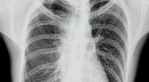 Chest Tube Bukan Terapi Lini Pertama pada Pneumotoraks Spontan Primer
