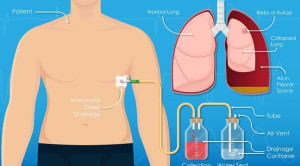 Penggunaan Chest Tube Drainage VS Aspirasi Jarum Pada Kasus Primary Spontaneous Pneumothorax