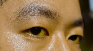 Penanganan Painless Jaundice pada Pasien Dewasa