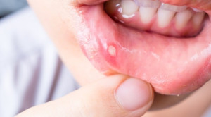 Apakah Defisiensi Vitamin D Merupakan Faktor Risiko Recurrent Aphthous Stomatitis?