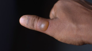 Bullae Luka Bakar: Apakah Harus Dipecahkan?