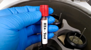 Deteksi Dini Kanker Ovarium: Peran Human Epididymis Protein 4