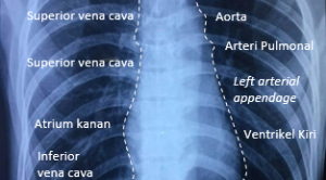 Interpretasi Rontgen Toraks