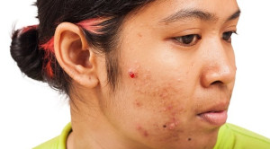Gel Dapsone untuk Terapi Acne Vulgaris