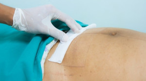 Ropivacaine dan Ketorolac Wound Infusion Sebagai Analgetik Pasca Operasi Cesar: Sebuah Uji Acak Terkontrol – Telaah Jurnal Alomedika