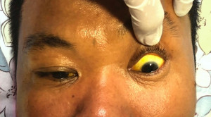 Komplikasi Hepatitis A yang Tidak Umum