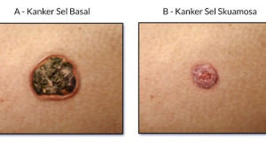 Hydrochlorothiazide Meningkatkan Risiko Terkena Karsinoma Sel Basal dan Skuamosa