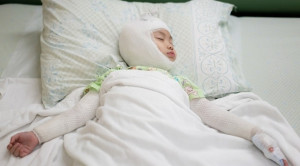 Efikasi Wet Dressing Menggunakan Topikal Kortikosteroid pada Anak dengan Dermatitis Atopik