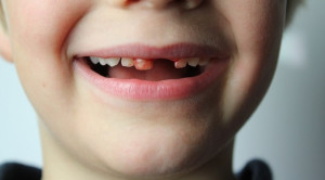 Efek Tea Bag untuk Menghentikan Pendarahan Setelah Cabut Gigi