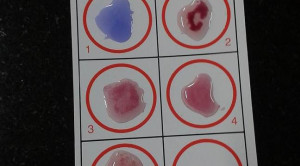 Akurasi Tes Widal dan Tubex untuk Diagnosis Tifoid